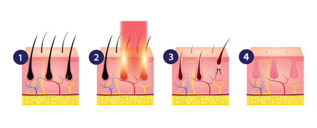 Diode Laser Hair Removal Singapore