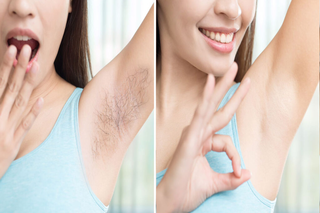 Brazilian laser hair removal