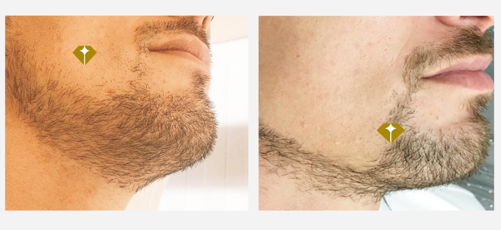 beard laser hair removal