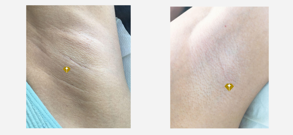 permanent laser hair removal