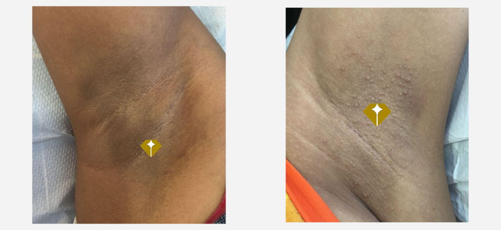 permanent laser hair removal