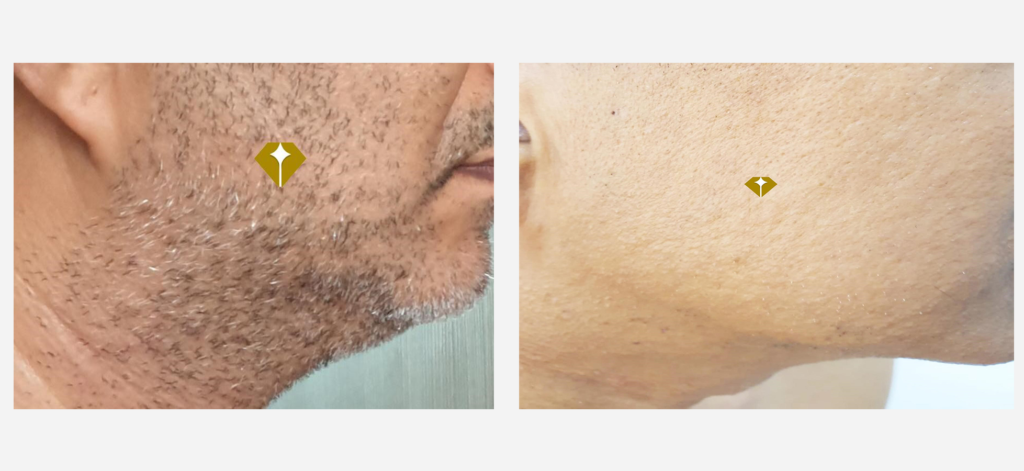 beard hair removal