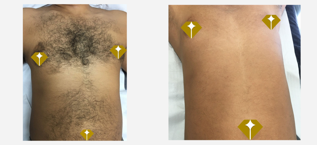 Man hair removal