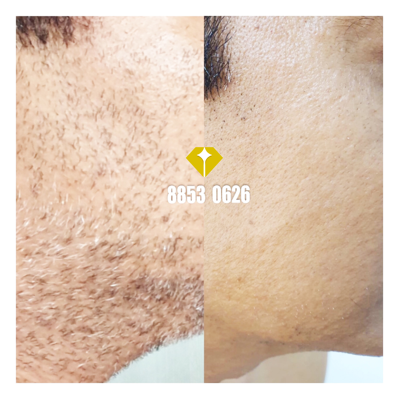 Laser Hair Removal for Men