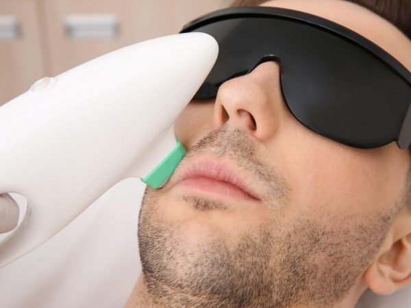 male laser hair removal upper lip