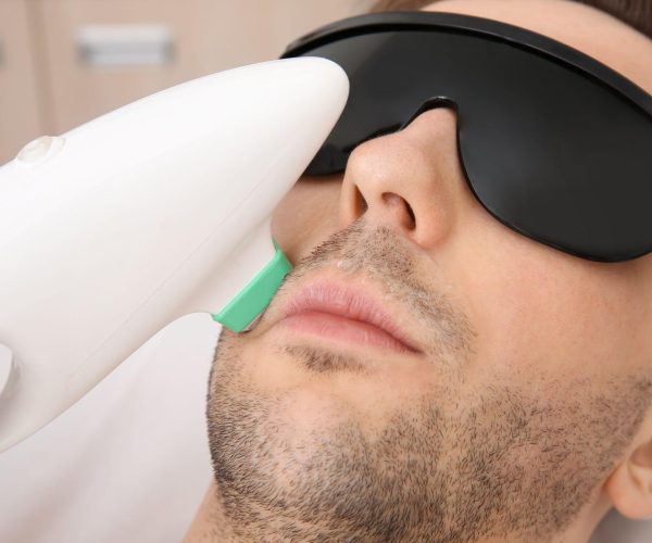 male laser hair removal upper lip