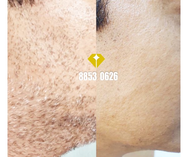 Laser Hair Removal for Men